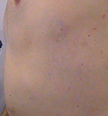 690912-centro-dermatologico-dr-galvan-perez-del-pulgar-eliminacion-de-lesiones-pigmentadas-y-tatuajes-18