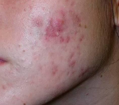 tratamiento de cicatrices del acné