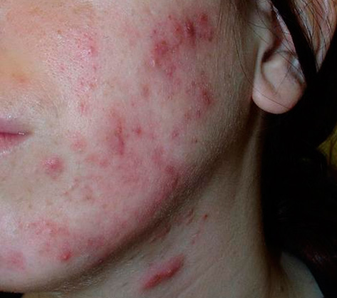 tratamiento de cicatrices del acné