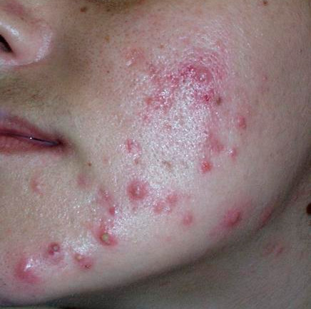 691282-centro-dermatologico-dr-galvan-perez-del-pulgar-acne-1