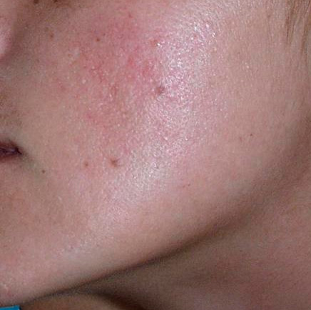 691283-centro-dermatologico-dr-galvan-perez-del-pulgar-acne-2